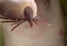 Lyme Disease: Symptoms, Causes, Treatment & Prevention Lyme-Disease